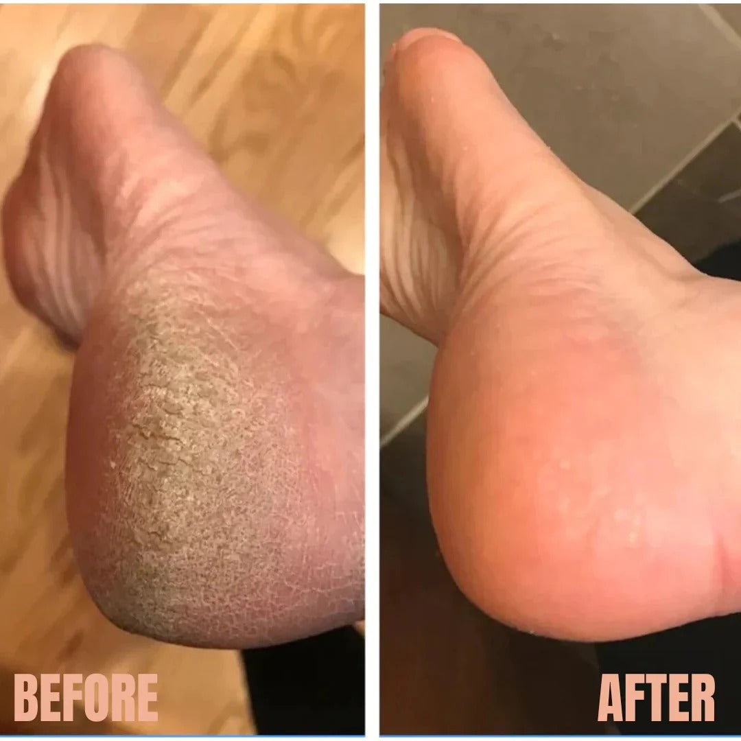 Electric Pedicure Dead Skin Remover