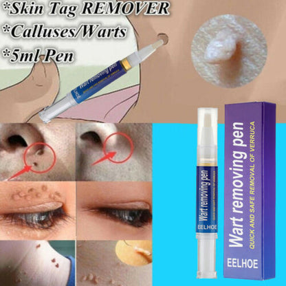 Warts Remover Original Cream Wart Removal Ointment Wart Treatment Skin Tag Mole Remover Antibacterial Foot Wart